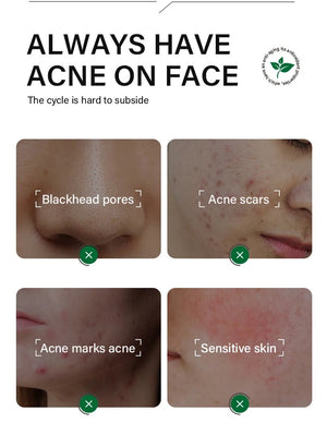 FORT Salicylic Acid Serum – Anti-Acne & Dark Spot Correcting (30ml)