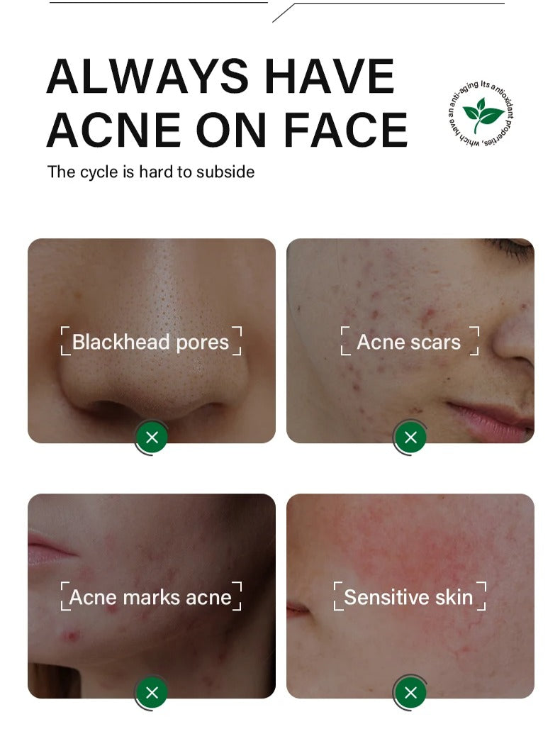 FORT Salicylic Acid Serum – Anti-Acne & Dark Spot Correcting (30ml)