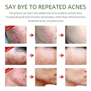 FORT Salicylic Acid Serum – Anti-Acne & Dark Spot Correcting (30ml)
