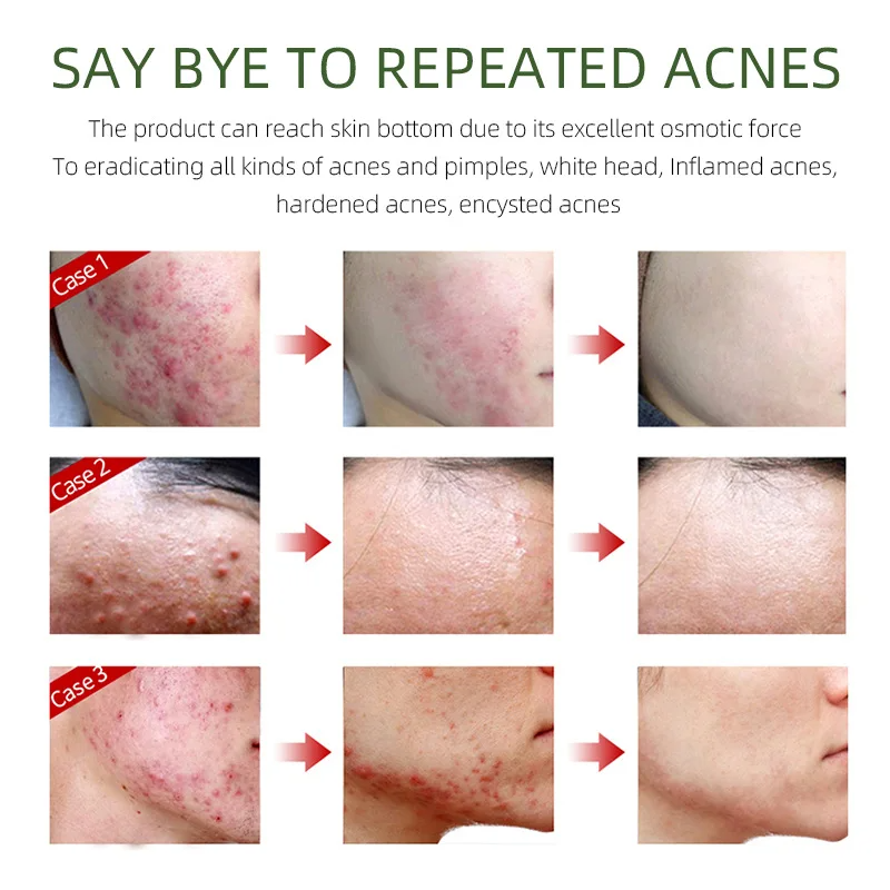 FORT Salicylic Acid Serum – Anti-Acne & Dark Spot Correcting (30ml)