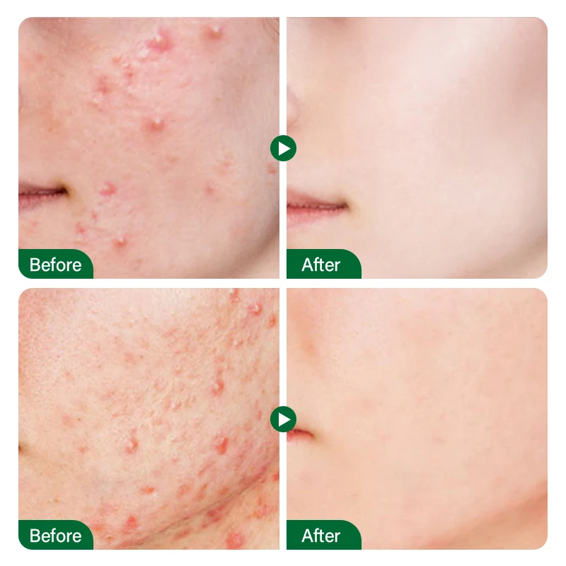 FORT Salicylic Acid Serum – Anti-Acne & Dark Spot Correcting (30ml)